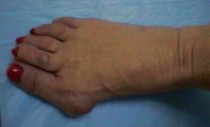 Typical Bunion
